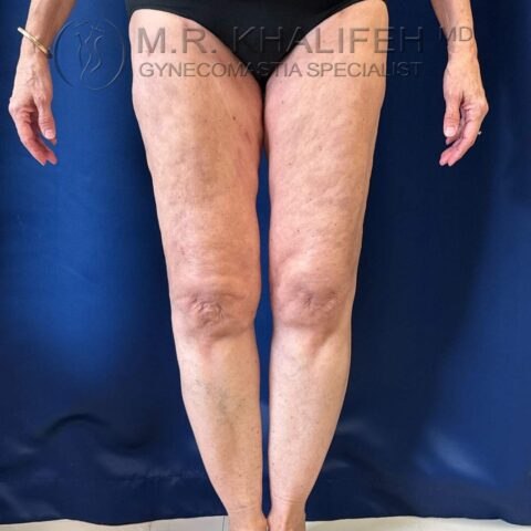 Lipedema after markings front view