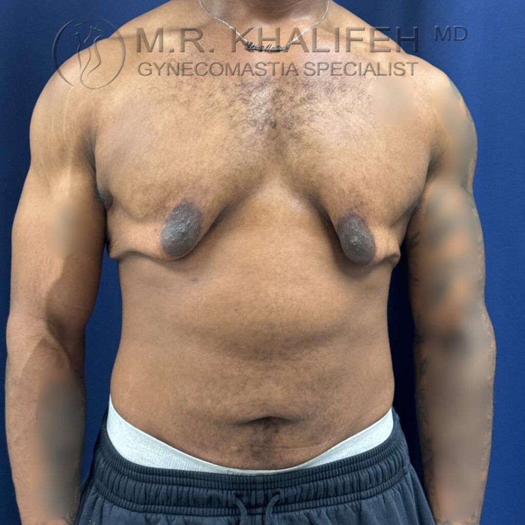 1 Before Gynecomastia Surgery – Front View – 25 Nov 2025.jpg