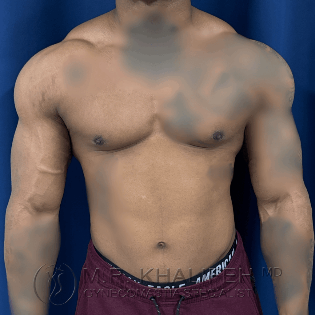 1 Gynecomastia surgery – post op – 2026 03 15 – front view.png