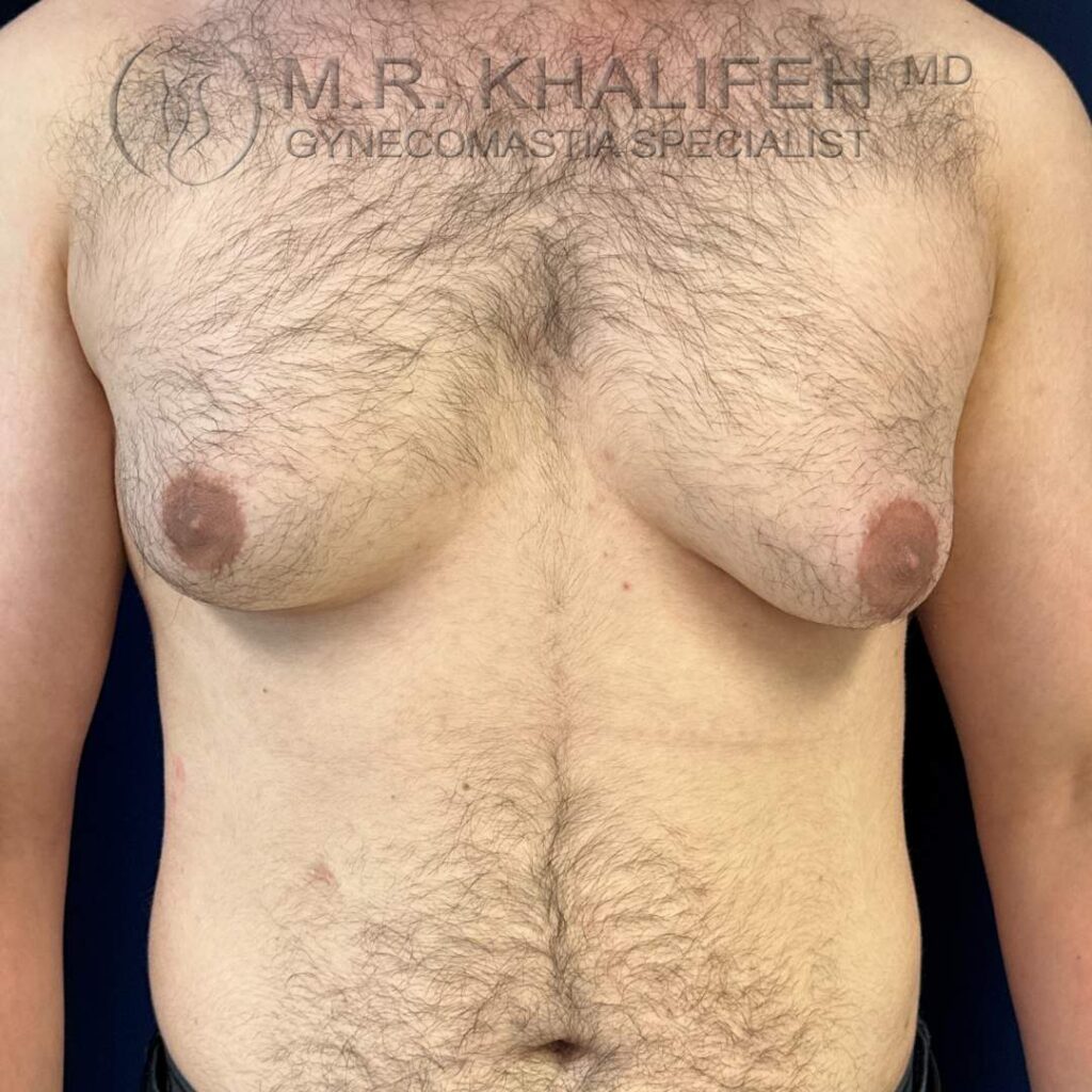 1 before front with skin excess.jpg