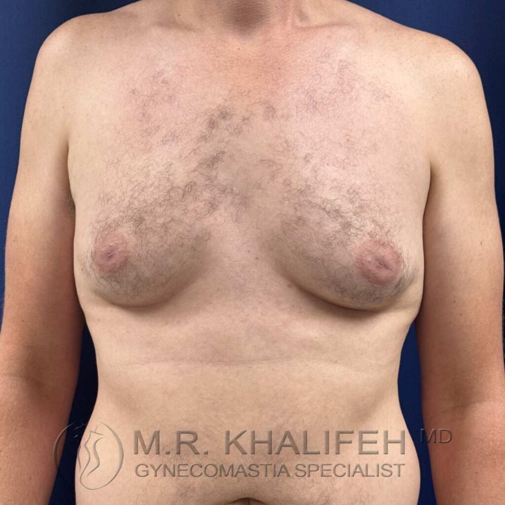 1 before gynecomastia front 18 12 2025.jpg