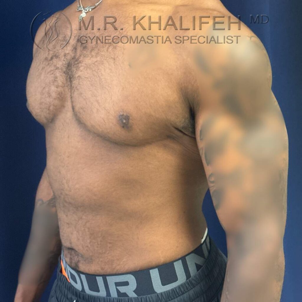 10 After Gynecomastia Surgery – Half Side View Right – 25 Nov 2025.jpg