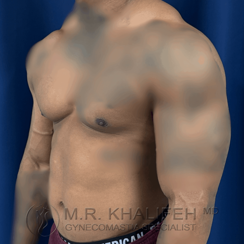 10 Gynecomastia surgery – post op – 2026 03 15 – left oblique view.png