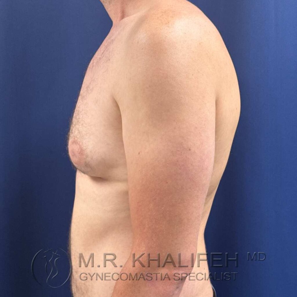 10 before gynecomastia left side 18 12 2025.jpg