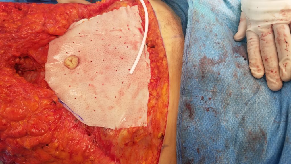 1582753464 tummy tuck hernia