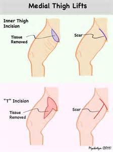 1582924804 thigh liposuction
