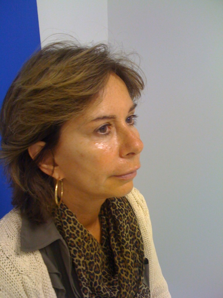 1583261832 liquid facelift image3