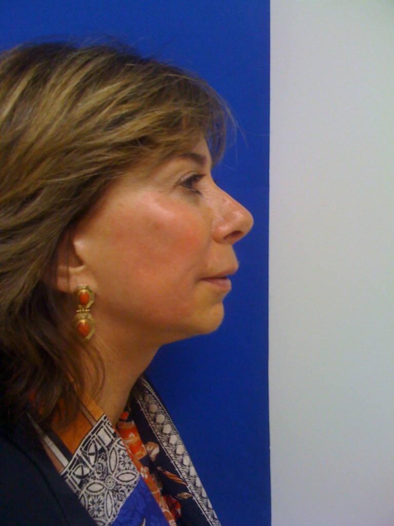 1583261836 liquid facelift image4