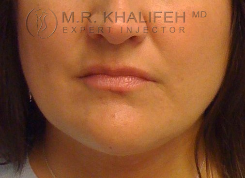 1583262645 lip augmentation image2
