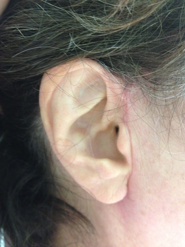 1583773697 facelift scars image
