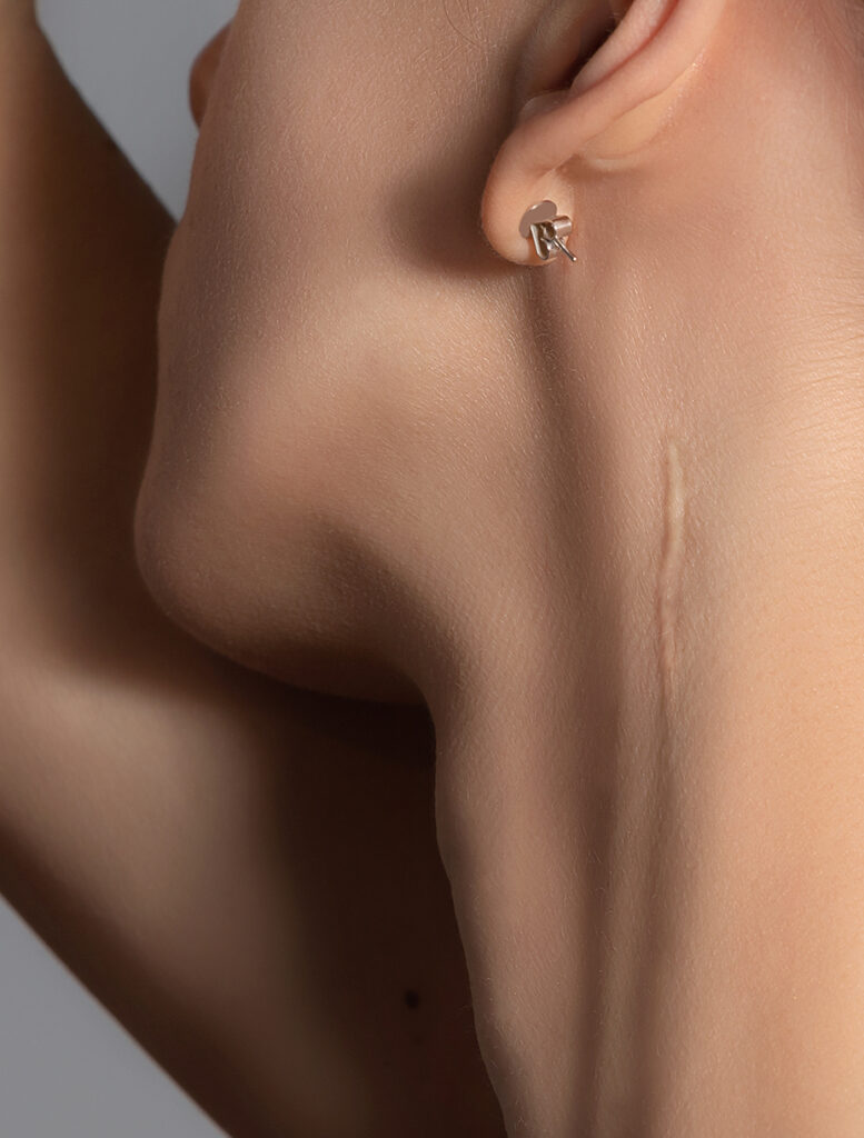 1583797235 keloid scar