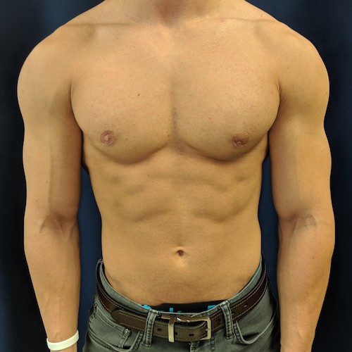 1584118204 2 07082019puffynippleafter.jpg