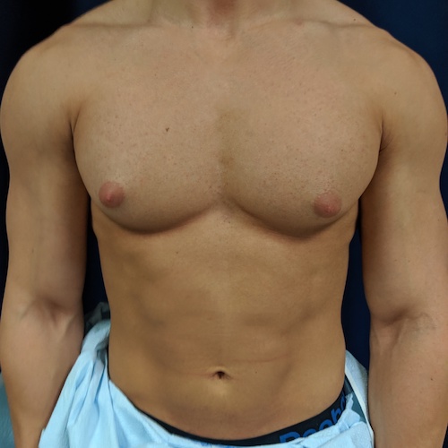 1584118208 1 07082019puffynipplebefore.jpg