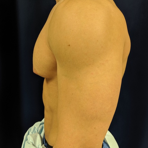 1584118213 3 07082019puffynipplebefore.jpg