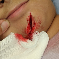 1584119962 scar revision ba
