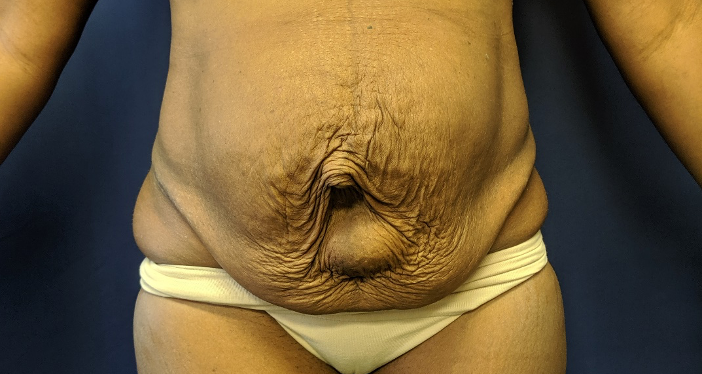 1590181464 tummytuckcomplication