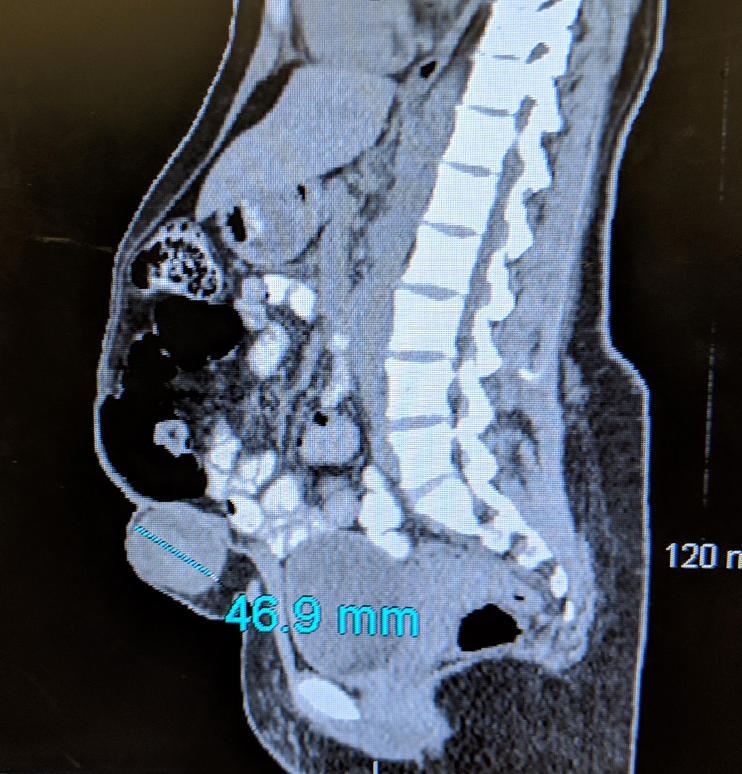 1590181749 tummytuckimage