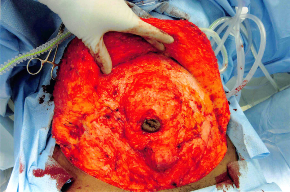 1590182987 tummytuck