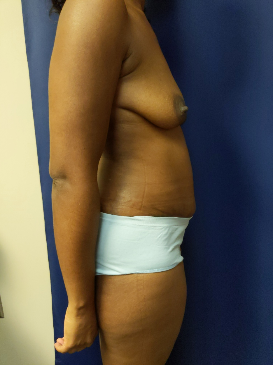 1590183369 tummyresults1
