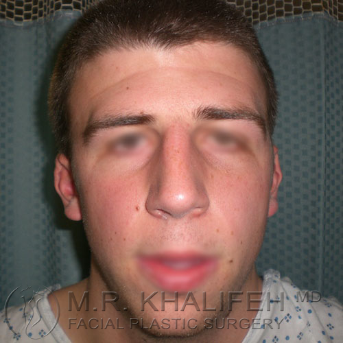 1590775364 rhinoplasty 1 before.jpg