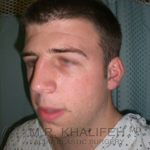 1590775375 rhinoplasty 3 before.jpg