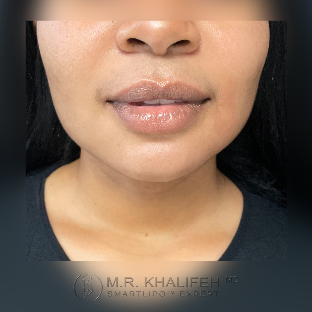 1648650394 1after 1.jpg