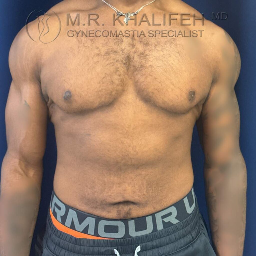 2 After Gynecomastia Surgery – Front View – 25 Nov 2025.jpg