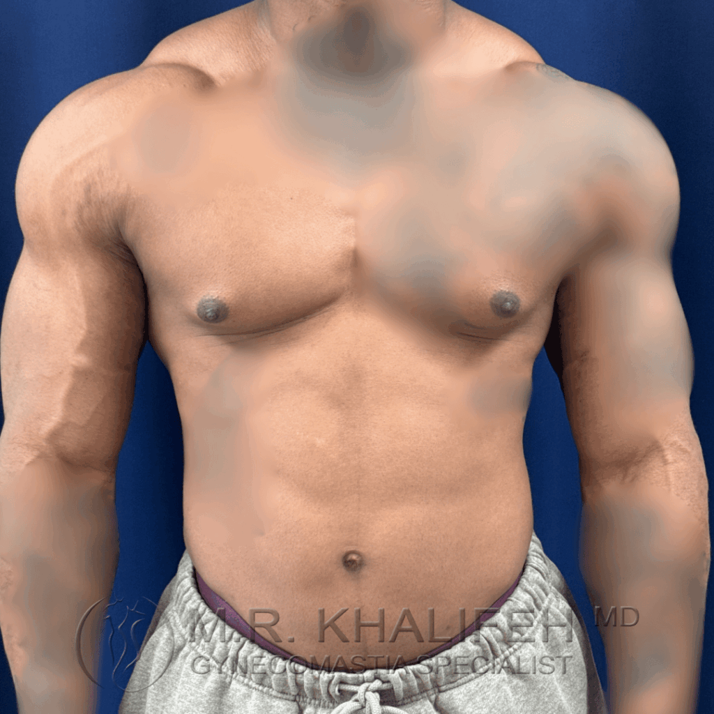 2 Gynecomastia surgery – pre op – 2026 01 28 – front view.png