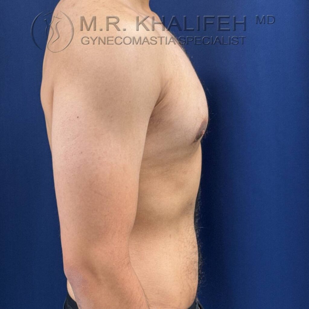 2 Gynecomastia – Right Side After – 2025 10 01.jpg