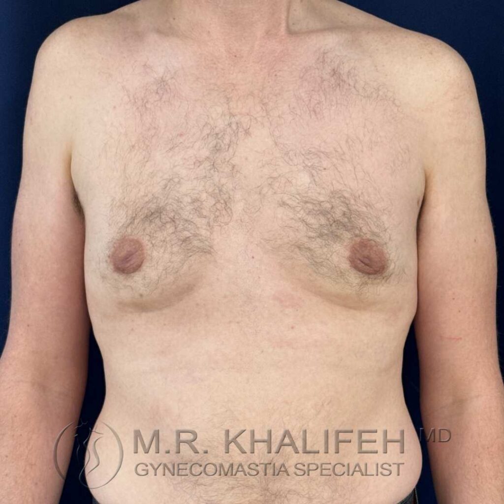 2 after gynecomastia front 18 12 2025.jpg