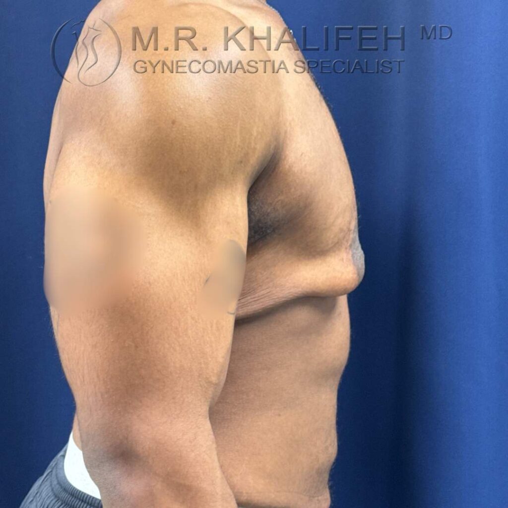 3 Before Gynecomastia Surgery – Side View Right – 25 Nov 2025.jpg