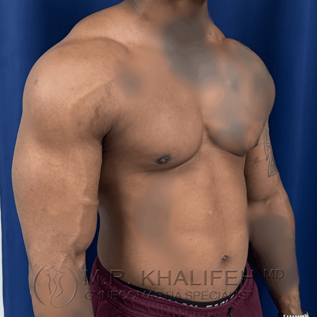3 Gynecomastia surgery – post op – 2026 03 15 – right oblique view.png