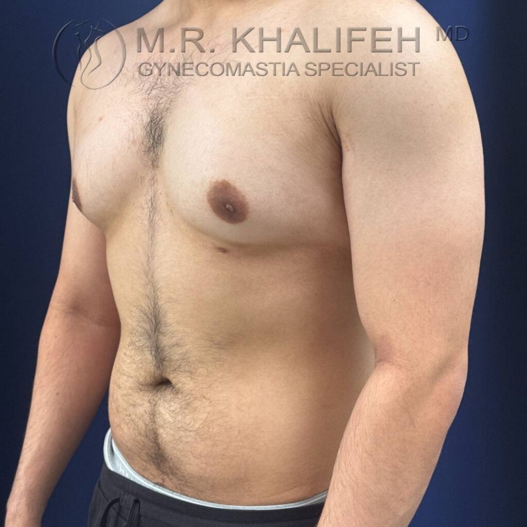 3 Gynecomastia – Left ¾ View Before – 2025 10 01.jpg