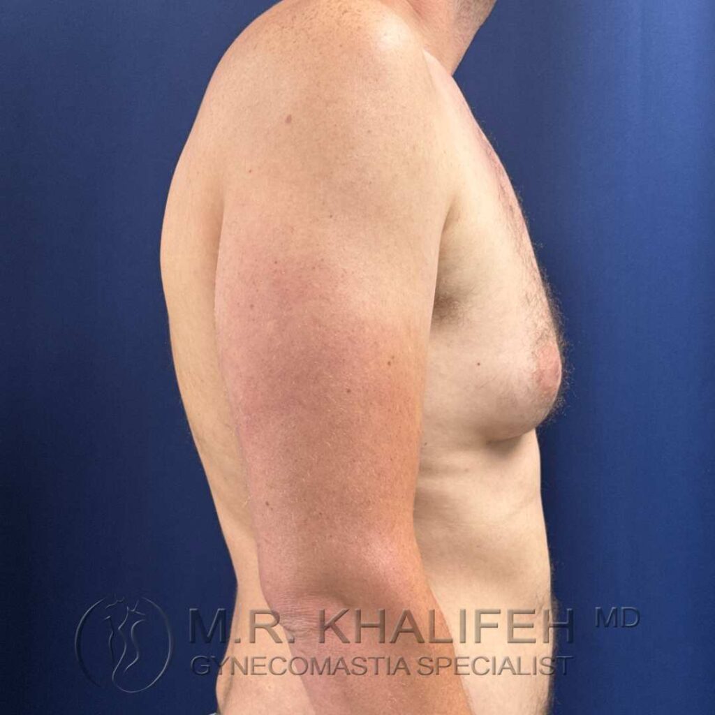 3 before gynecomastia right side 18 12 2025.jpg
