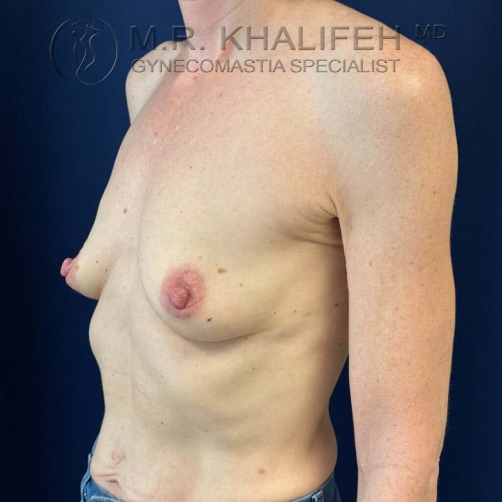 3 breast augmentation three quater side view before.jpg