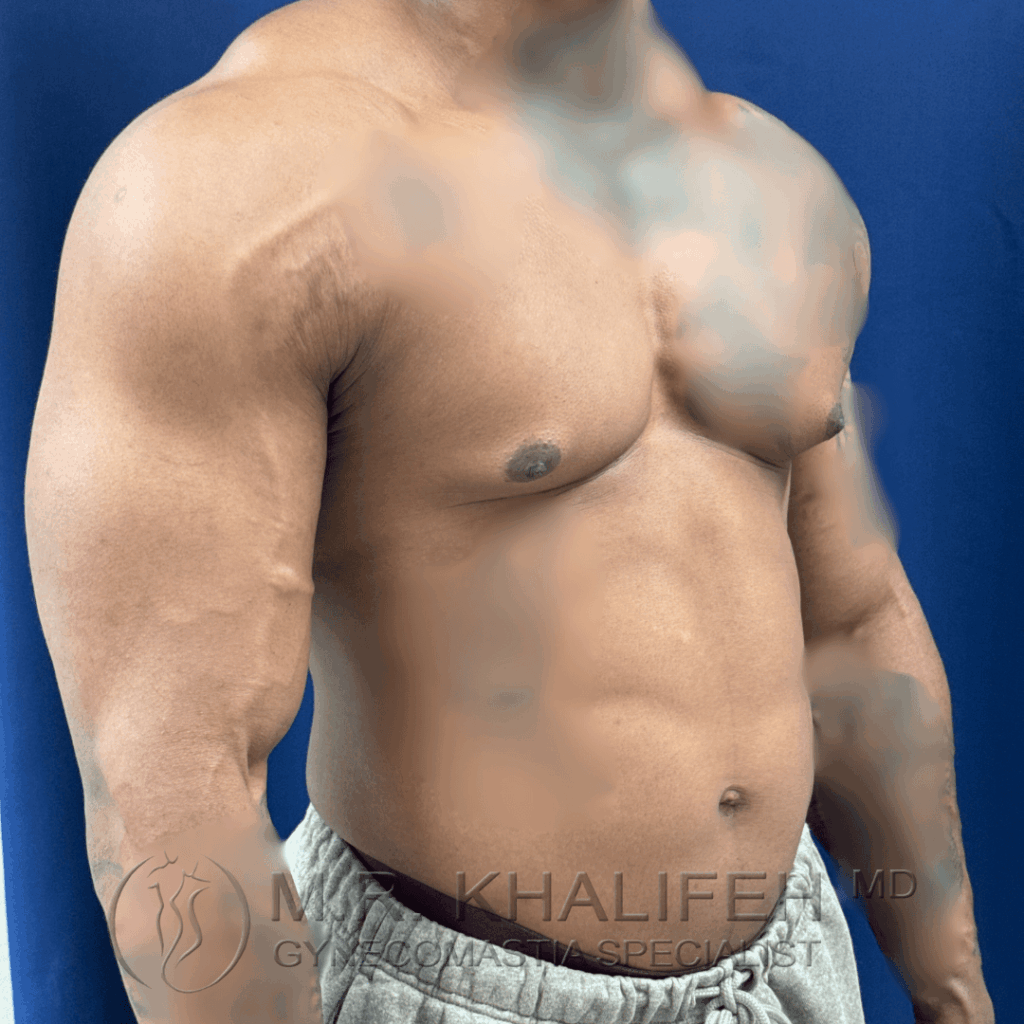 4 Gynecomastia surgery – pre op – 2026 01 28 – right oblique view.png
