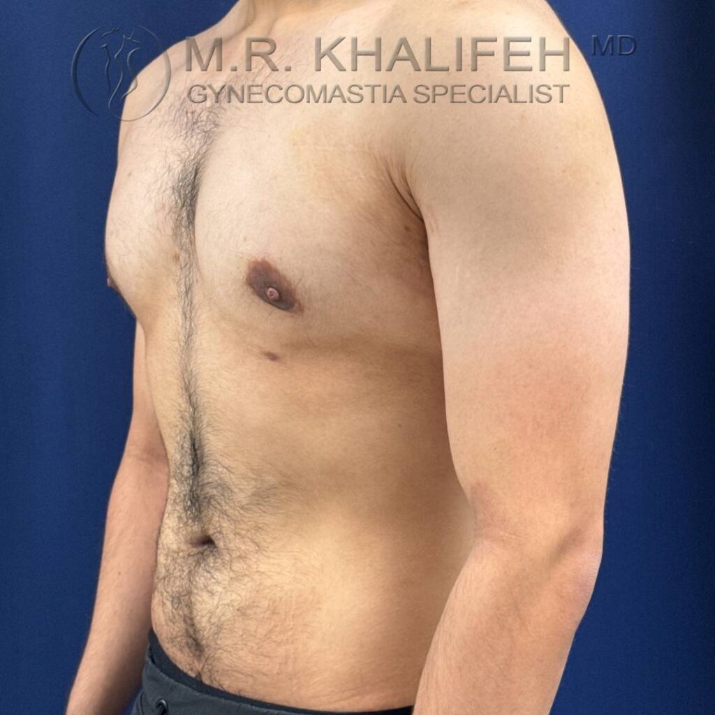4 Gynecomastia – Left ¾ View After – 2025 10 01.jpg