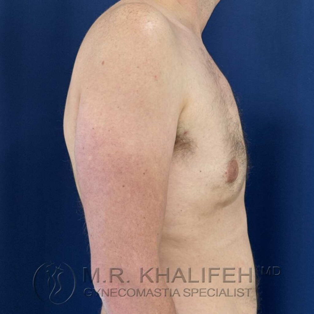 4 after gynecomastia right side 18 12 2025.jpg