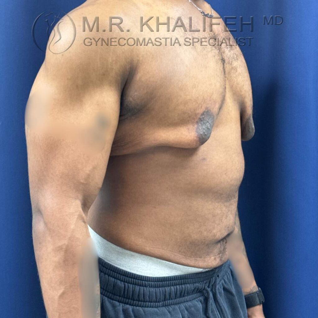 5 Before Gynecomastia Surgery – Half Side View Left – 25 Nov 2025.jpg