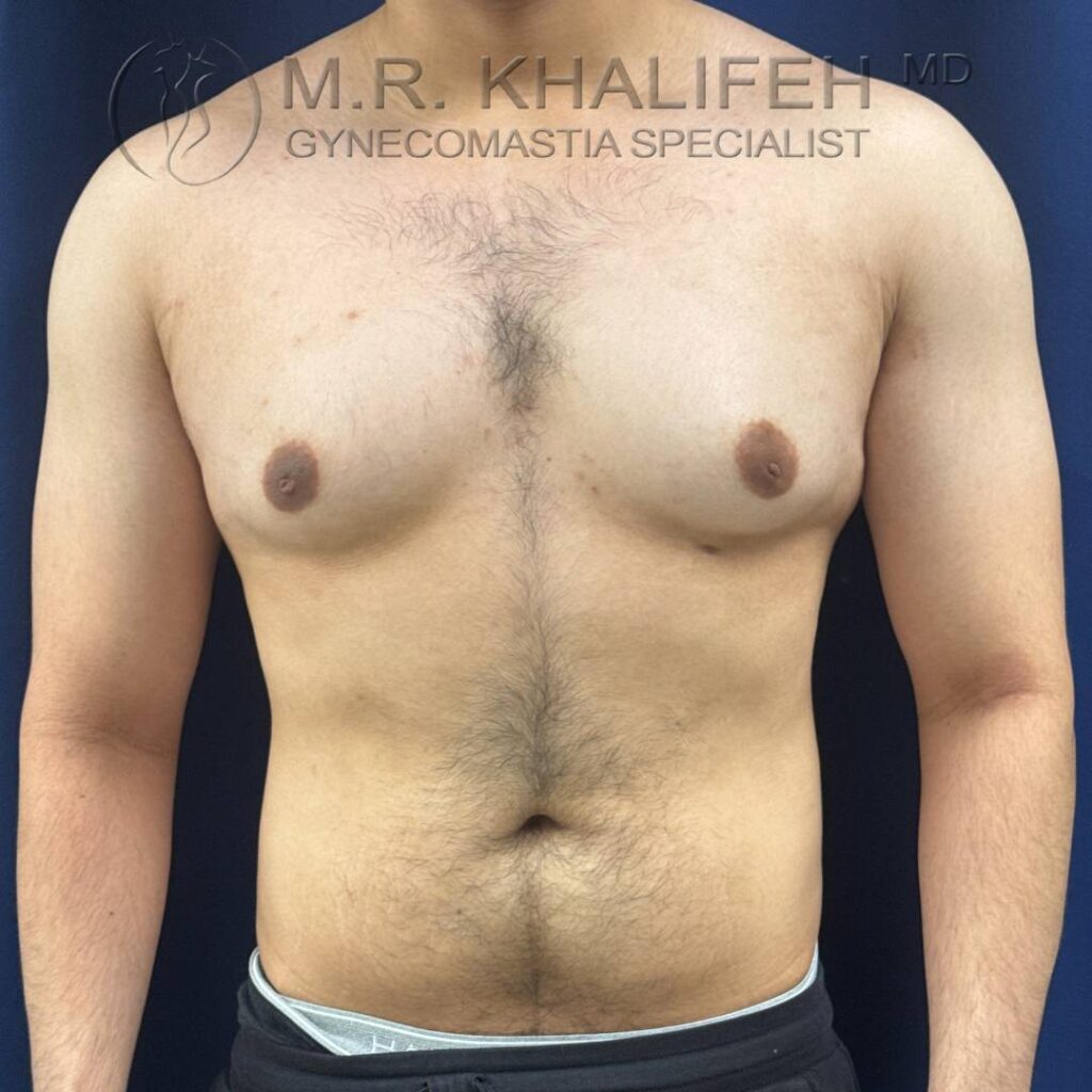 5 Gynecomastia – Front View Before – 2025 10 01.jpg