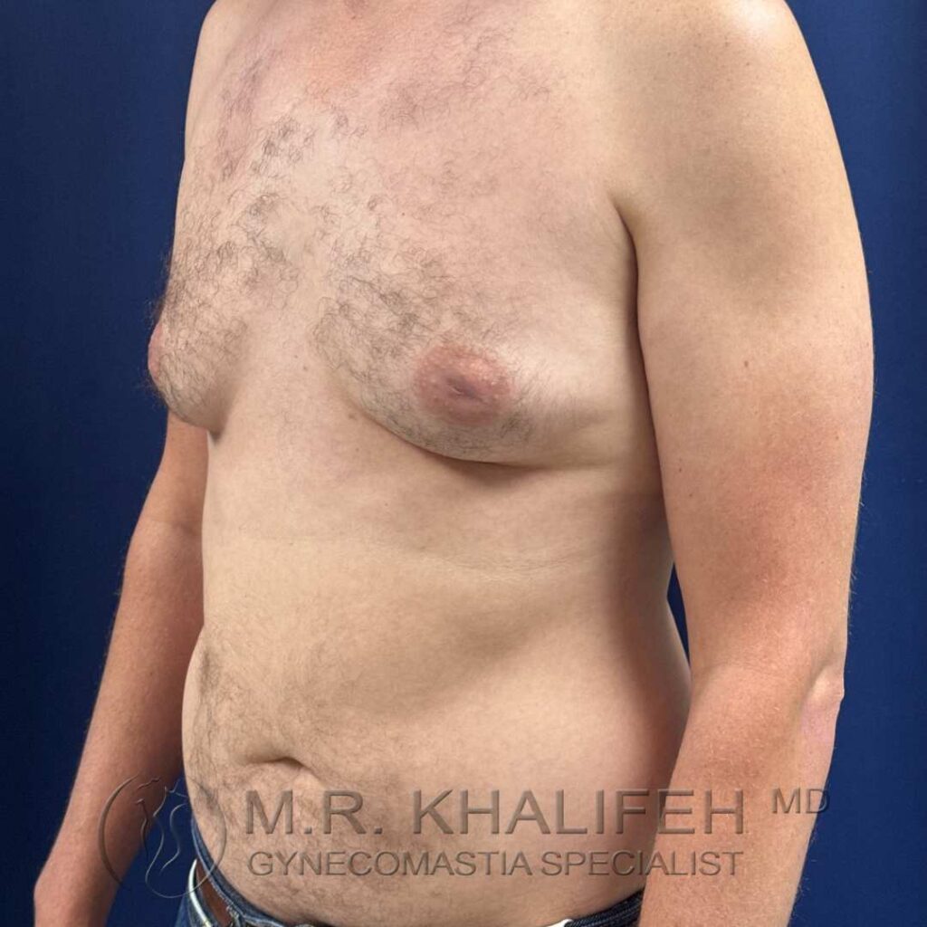 5 before gynecomastia left quarter side 18 12 2025.jpg