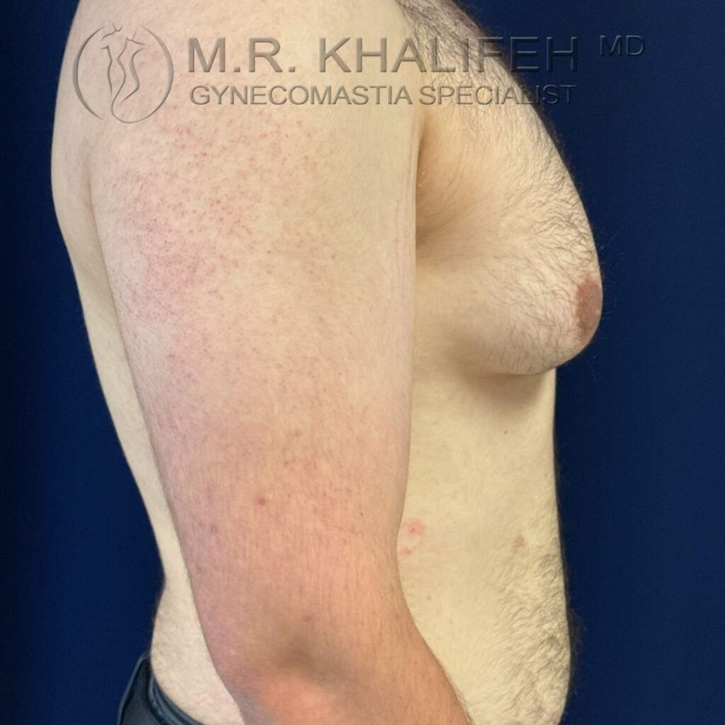 5 before side right with skin excess.jpg