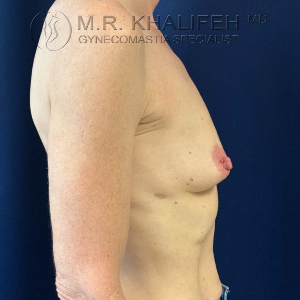 5 breast augmentation side view right before.jpg