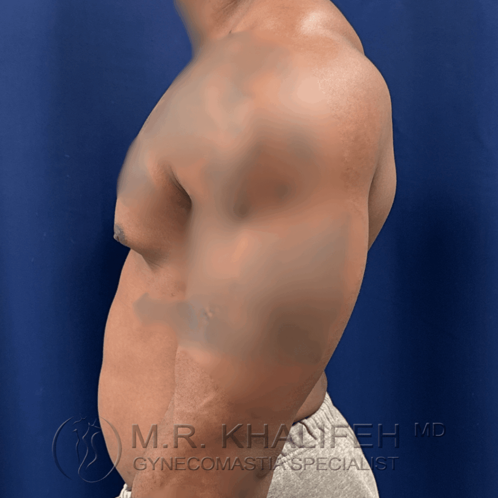 6 Gynecomastia surgery – pre op – 2026 01 28 – left side view.png