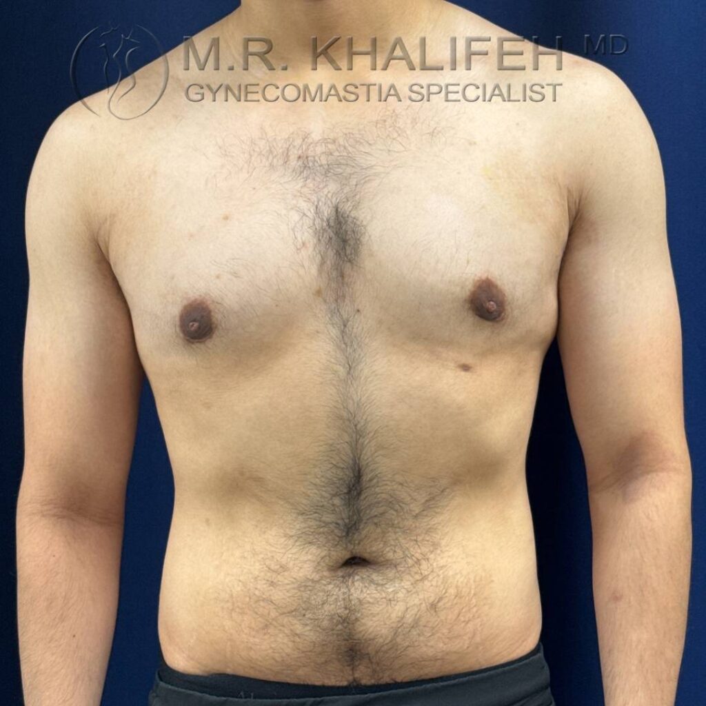 6 Gynecomastia – Front View After – 2025 10 01.jpg