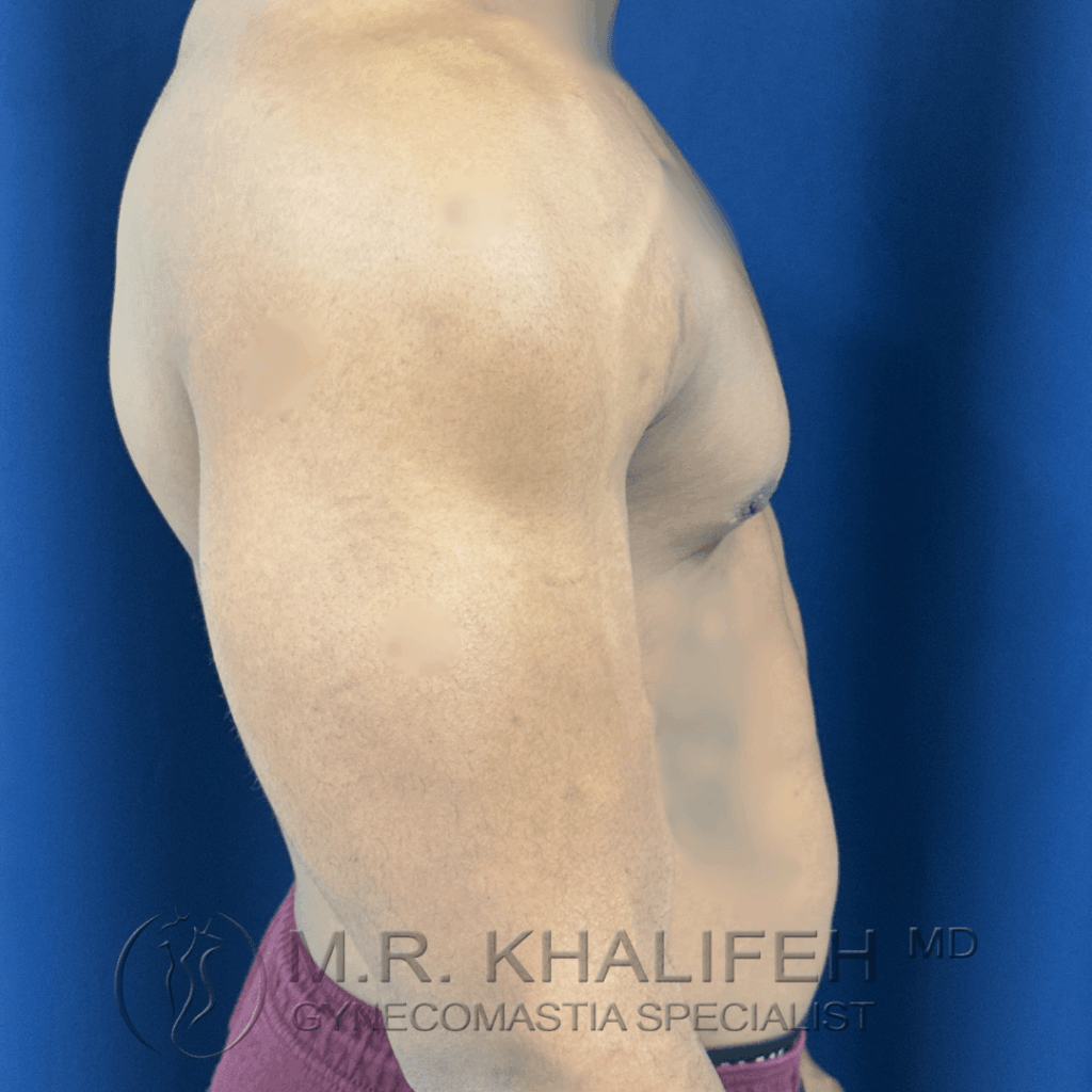 7 Gynecomastia surgery – post op – 2026 03 15 – right side view.png