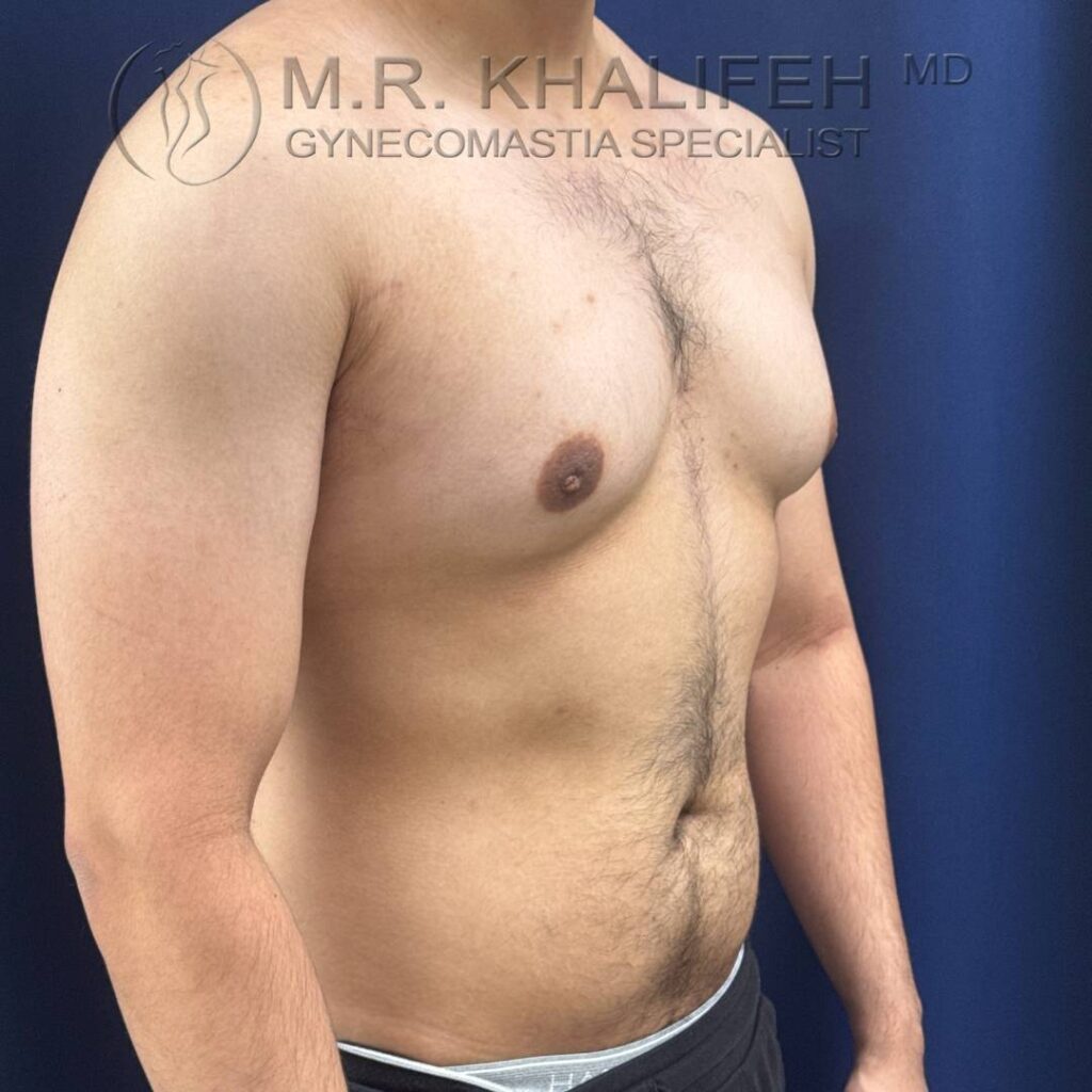 7 Gynecomastia – Right ¾ View Before – 2025 10 01.jpg