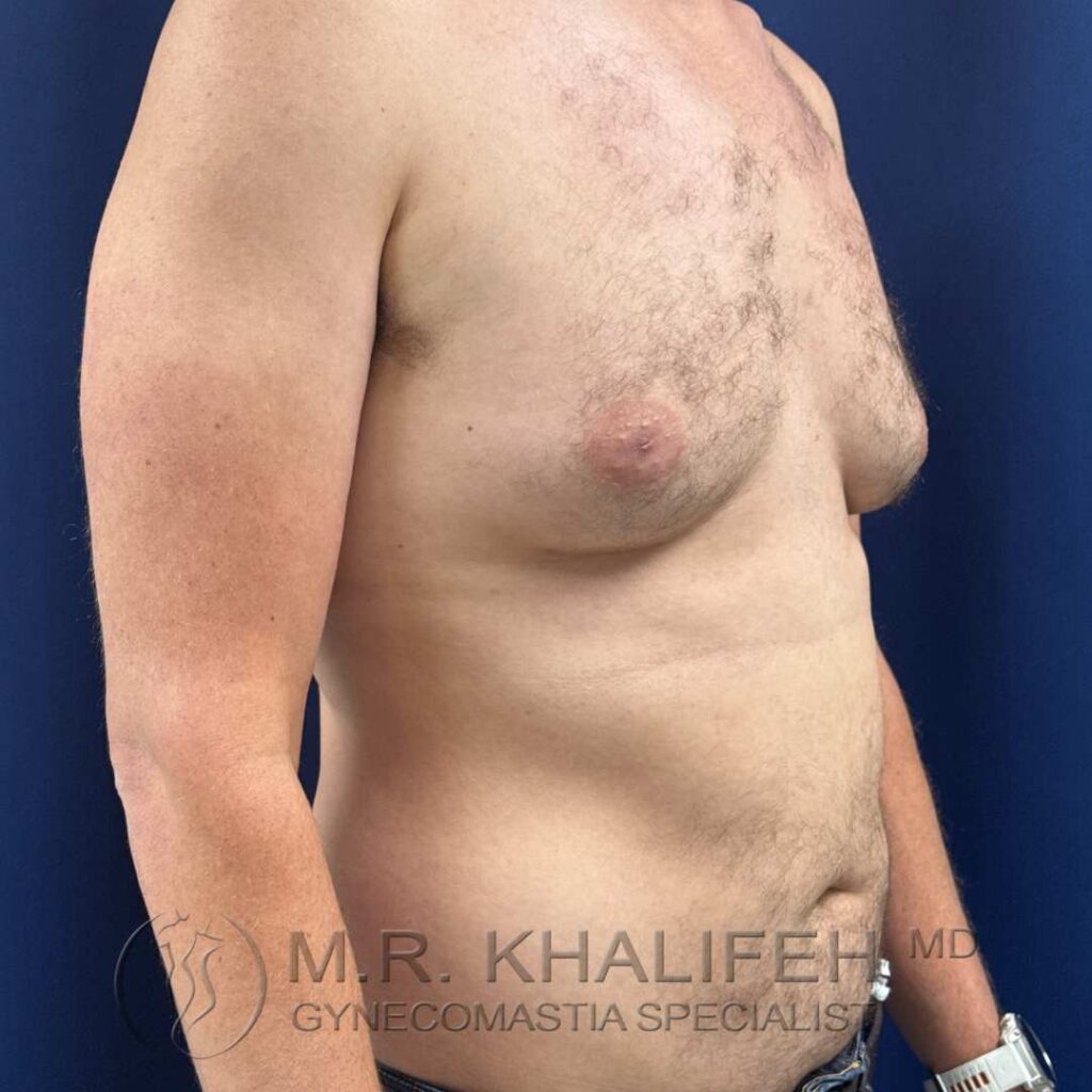 7 before gynecomastia right quarter side 18 12 2025.jpg