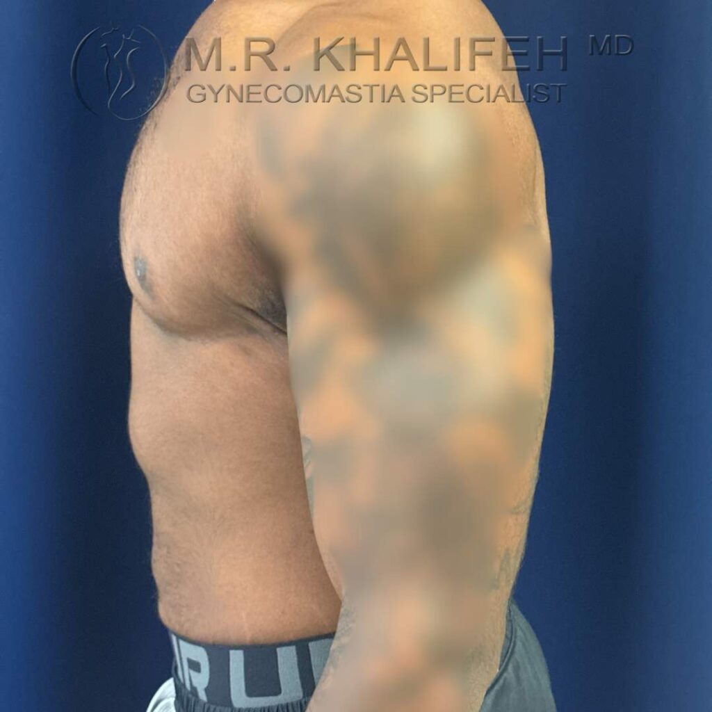 8 After Gynecomastia Surgery – Side View Left – 25 Nov 2025.jpg