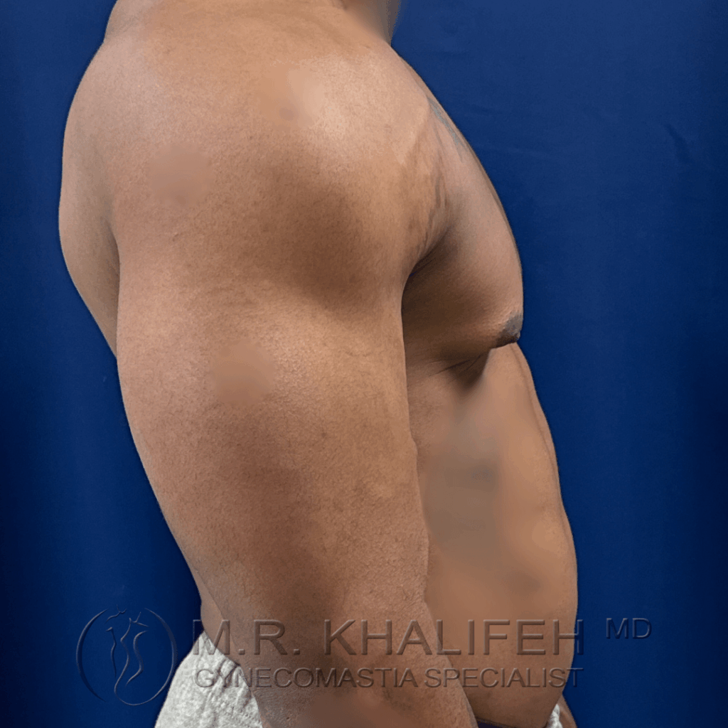 8 Gynecomastia surgery – pre op – 2026 01 28 – right side view.png